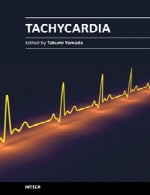 تاکی کاردی (تپش قلب)Tachycardia
