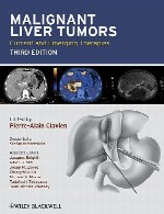 تومورهای کبدی بدخیم – درمان های حاضر و در حال ظهورMalignant Liver Tumors