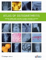 اطلس استئوآرتریت (آرتروز، استئوآرتروز)Atlas of Osteoarthritis