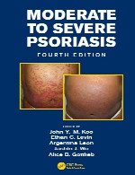 پسوریازیس متوسط تا شدیدModerate to Severe Psoriasis
