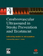 اولتراسوند عروق مغزی در پیشگیری و درمان سکته مغزیCerebrovascular Ultrasound in Stroke Prevention and Treatment