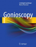ژونیوسکوپیGonioscopy