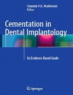 سمنت کاری در ایمپلنتولوژی دندانپزشکی – راهنمای مبتنی بر شواهدCementation in Dental Implantology