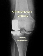 آرتروپلاستی - به روز رسانیArthroplasty - Update