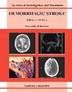Hemorrhagic stroke : an atlas of investigation and treatment